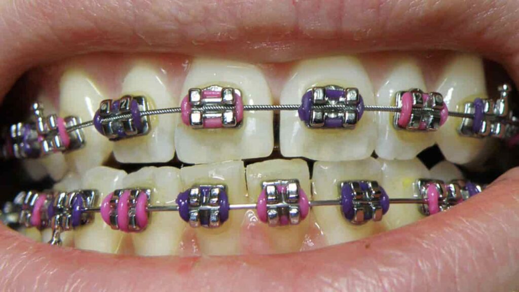 harga braces di klinik swasta terkini