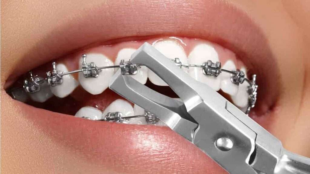 kekurangan mendapatkan braces di klinik swasta