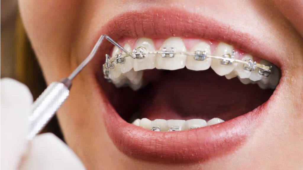 kelebihan memilih braces di klinik swasta