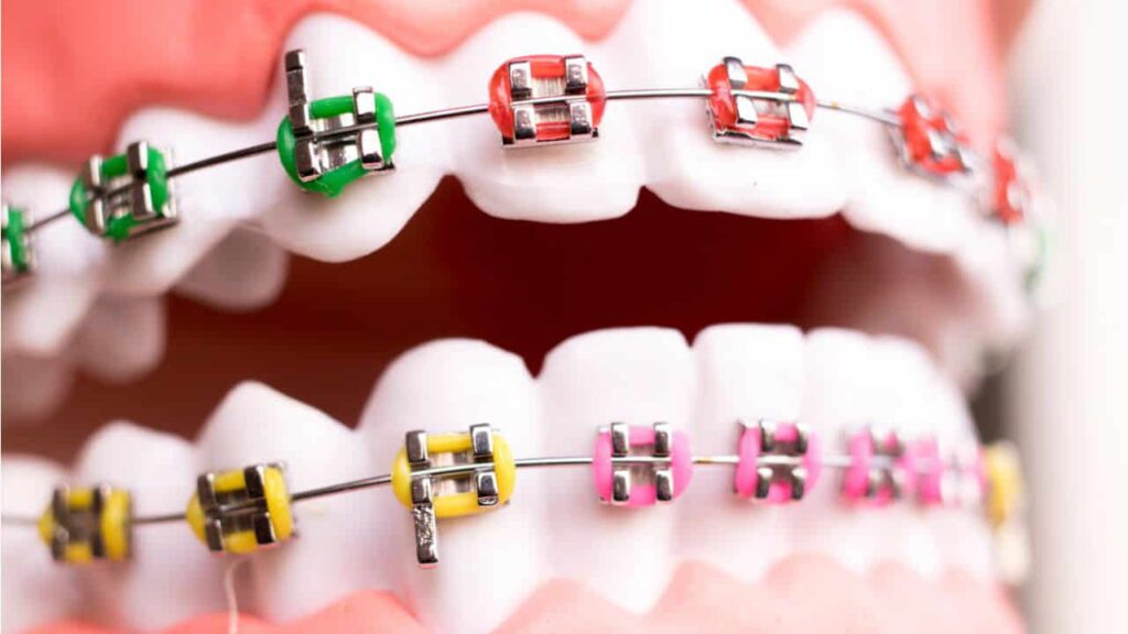 perbandingan harga braces di klinik kerajaan vs. klinik swasta