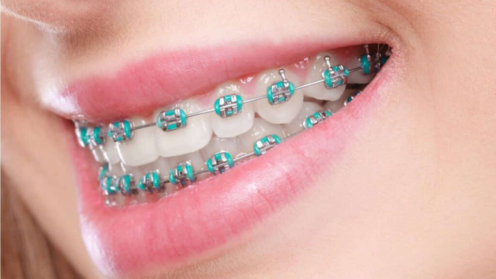 jenis braces di klinik kerajaan